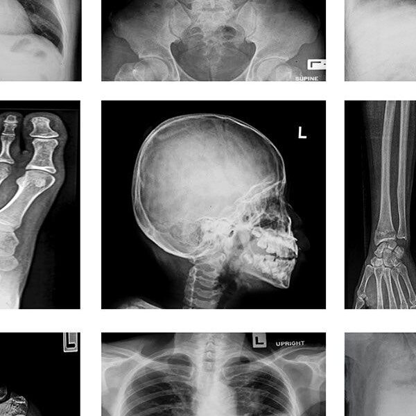 xrays