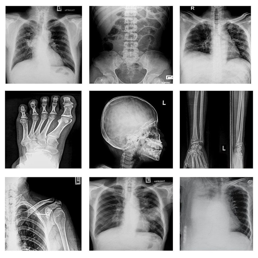 bone fracture img