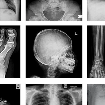 Multiple Bone Fractures