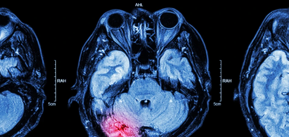 Lafayette Traumatic Brain Injury Lawyer-image